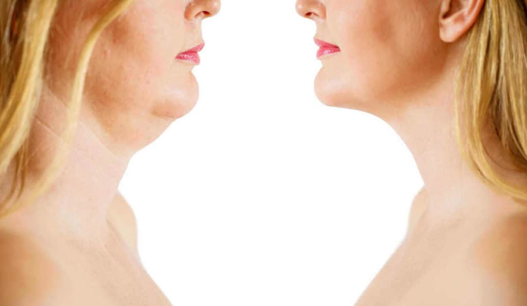 Double Chin treatment Greater Manchester before and after results
