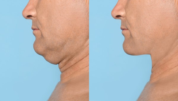 Which Non-Surgical Treatments Work Best for Jowls and Loose Skin Greater Manchester?