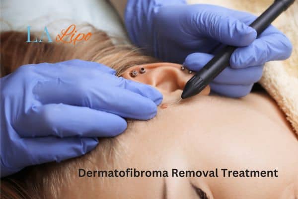 Dermatofibroma Removal Treatment Greater Manchester