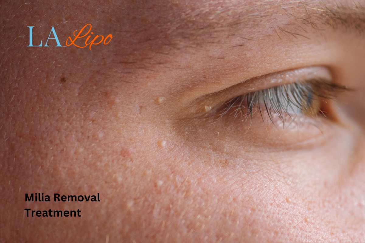 Cryopen Milia Removal: Is It the Easiest and Safest Option Greater Manchester?