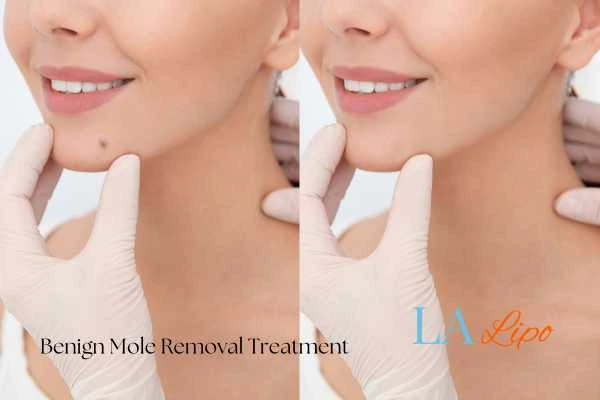 Before-and-after results following benign mole-removal treatment Greater Manchester