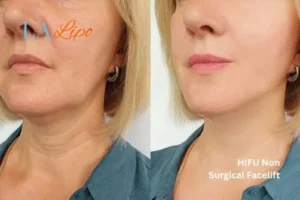 hi-fu for wrinkles Greater Manchester before and after results