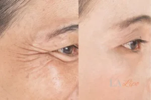 Before and after results of woman - HI-fu wrinkles reduction treatment Greater Manchester