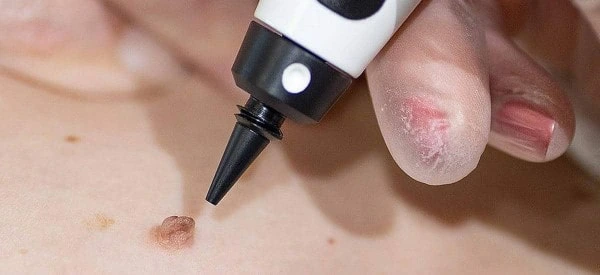 skin tag removal using cryopen Greater Manchester
