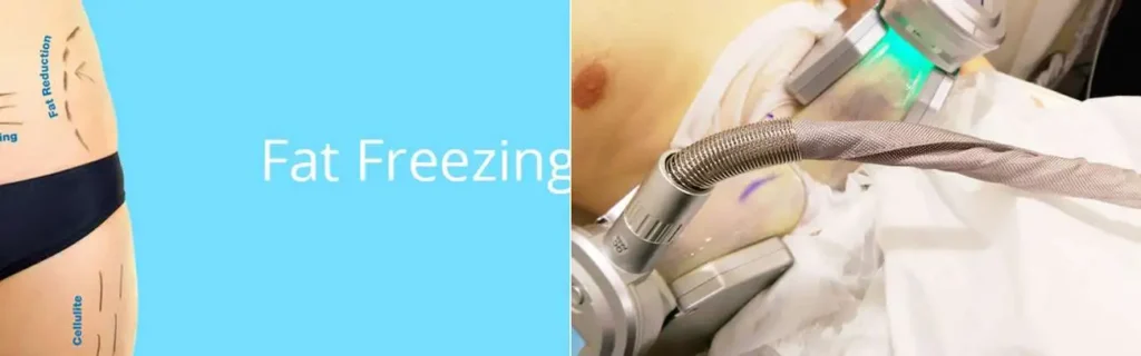 Fat freezing Greater Manchester on multiple areas of the body