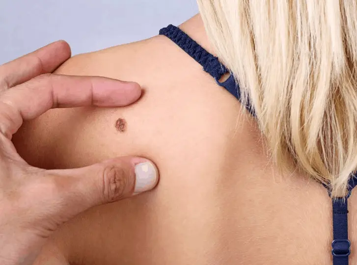 woman having mole removal Greater Manchester consultation before treatment.