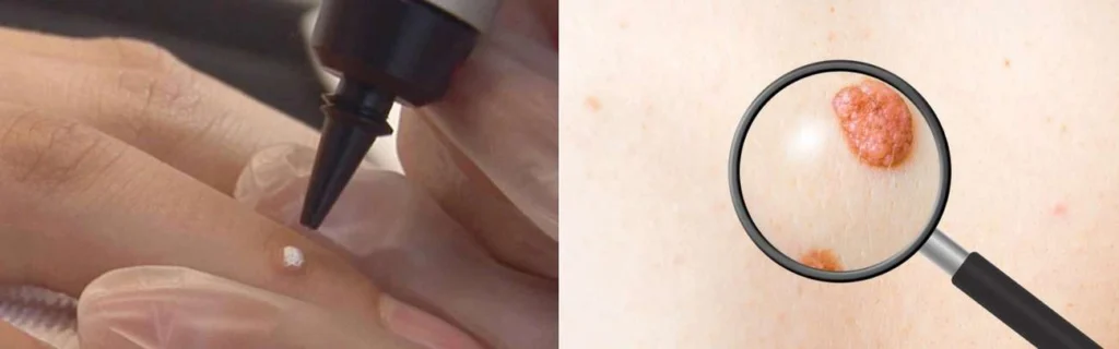 CryoPen practitioner Greater Manchester assessing a benign mole before treatment