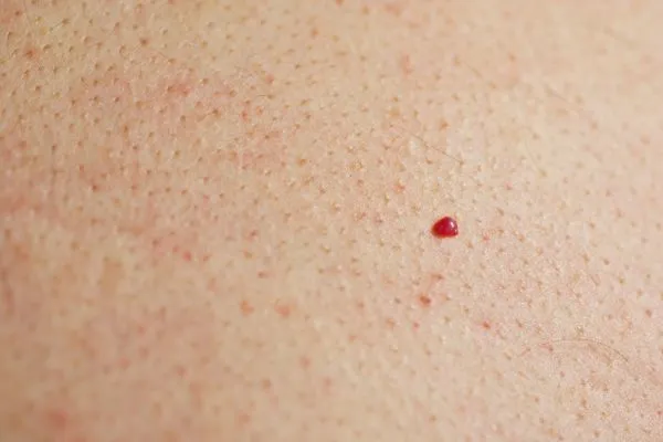 close up of a cherry angioma Greater Manchester