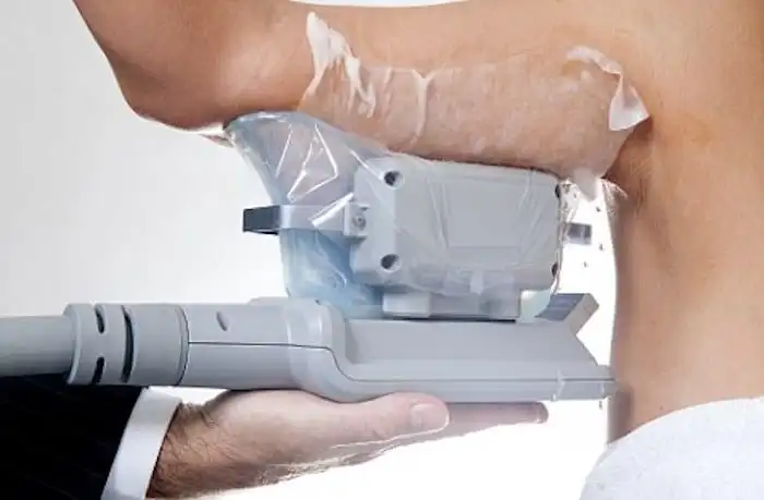 Picture of fat freezing Greater Manchester on the upper arms.