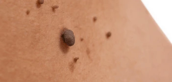 image of a skin tag Greater Manchester