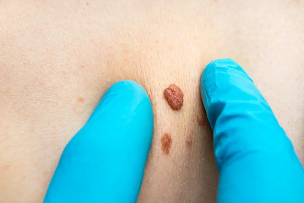 Consultant examining a skin tag Greater Manchester