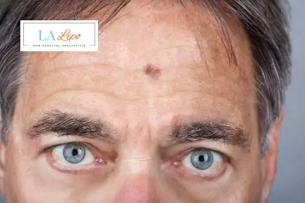 Solar Lentigo Removal Greater Manchester image of man with mark on his forehead
