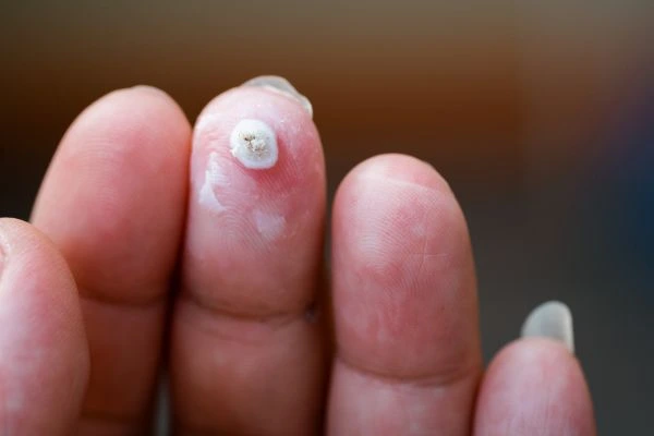wart on person finger - cryotherapy to treat from LA LIPO Greater Manchester