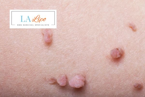 Does cryopen skin tag removal Greater Manchester hurt? Find out now call our team today!