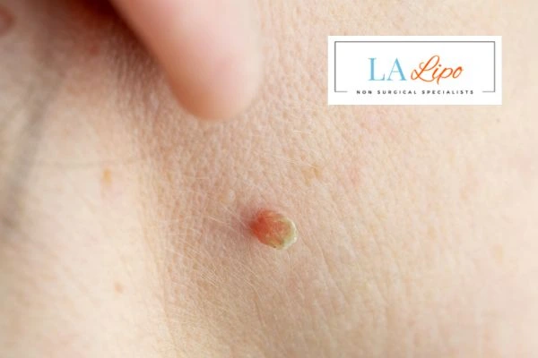 Book skin tag removal Greater Manchester today speak to our team now!