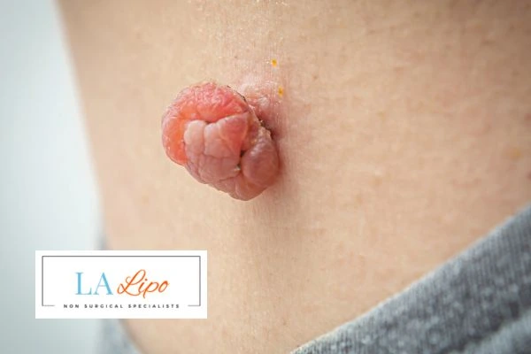 Interested in skin tag removal Greater Manchester? Concerned about the pain? Find out more today!