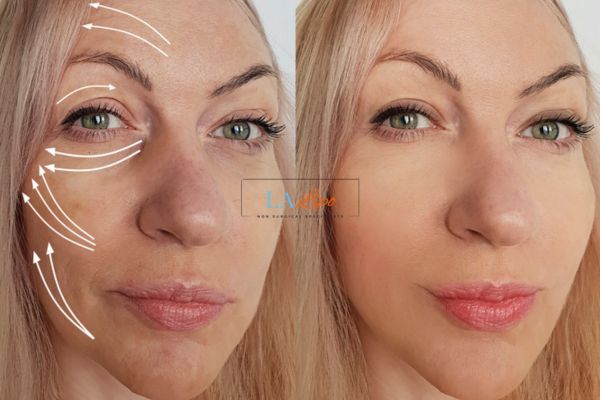 Morpheus 8 results Greater Manchester face lift.