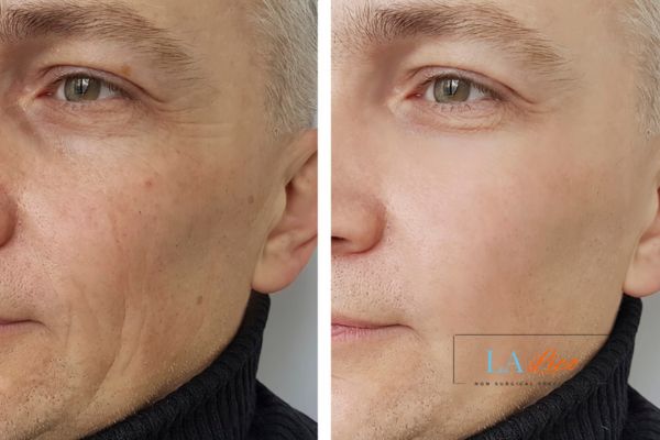 See the amazing results of Morpheus8 Treatment Greater Manchester!