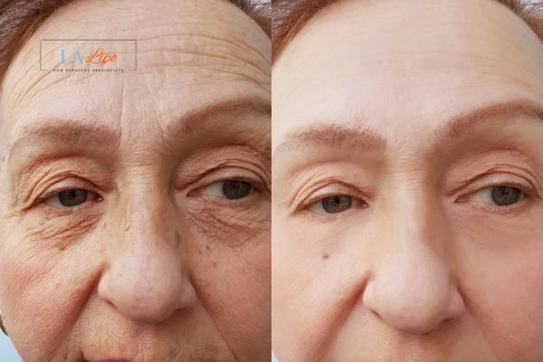 The powerful benefits of Morpheus8 Treatment Greater Manchester - Call Our team today!