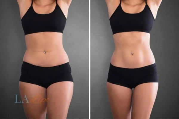 before and after results of non-surgical treatment to help a woman's body image and mental health Greater Manchester