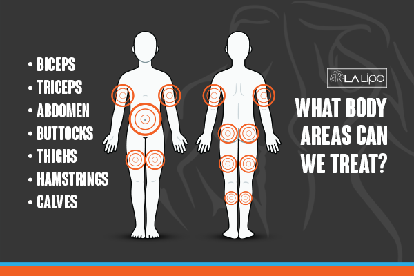 Diagram to show areas you can have LA-EMS Body Sculpting Treatment Greater Manchester
