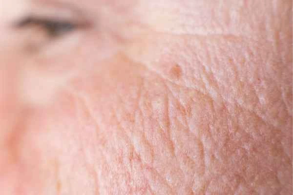 close up picture of a woman's face showing an age spot Greater Manchester