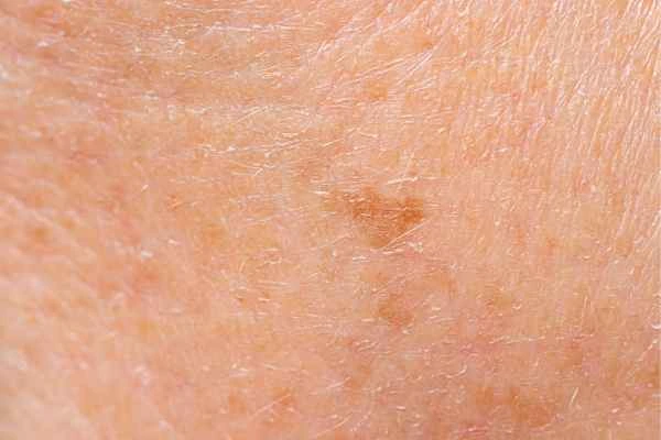 close up picture of age spots Greater Manchester