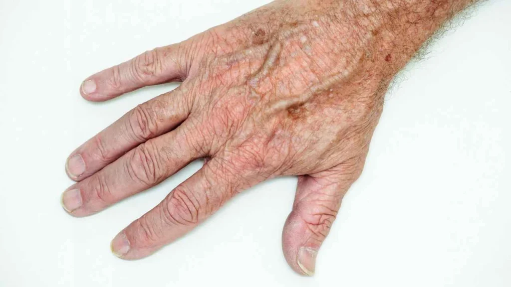 Male hand showing age spot Greater Manchester