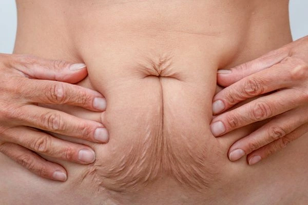 Image of a woman's stomach with loose skin - example of skin tightening Greater Manchester options