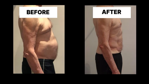 What Symptoms Can Diastasis Recti Cause in Men? Weak Core, Back Pain and Poor Posture Greater Manchester
